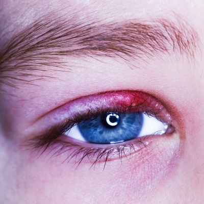 Painfull stye on eyelid