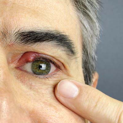 Man with Stye on eye