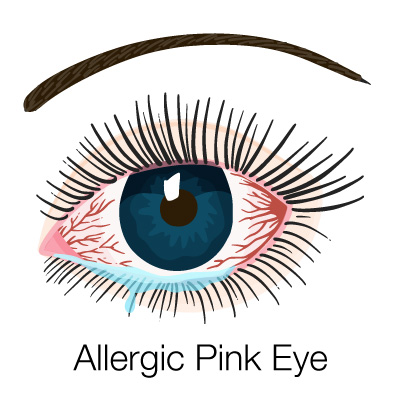 image of ellergic pink eye