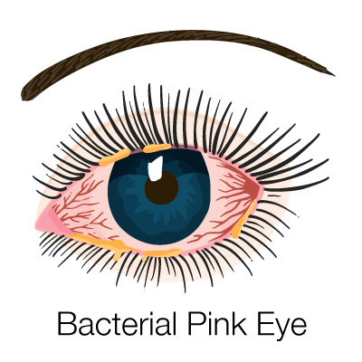 image of bacterial pink eye