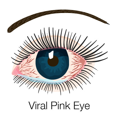 Image of viral pink eye
